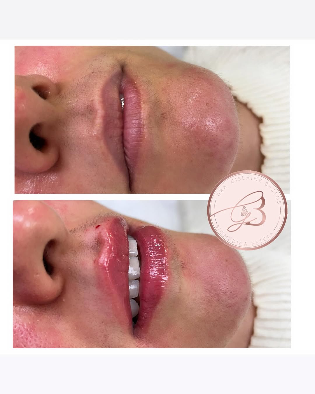 #clínicadeestéticariodasostras,
#clínicadeestéticar
#clínicadeestéticapertode-mim
#estética-avançada
 #botox
#preenchimento
#bioestimuladordecolágeno
#ultrassommicro
#ultrassommacrofocado
#radiofrequência
#limpezadepele
#massagemcorporal
#skinbooster
#esteticistaemriodasostras
#lavieen
#drgislainebastos
#hamonizacaofacial
#hamonizacaocorporal
#hamonizacaogluteos
#toxinabutalinica
#peelings
#tratamentomelasma
#gorduralocalizada
#celulite
#estrias
#fiosdepdo
#lineskin
#bioestimuladoresdecolageno
#rinotox
#abdomemtrincado
#modelagemnariz