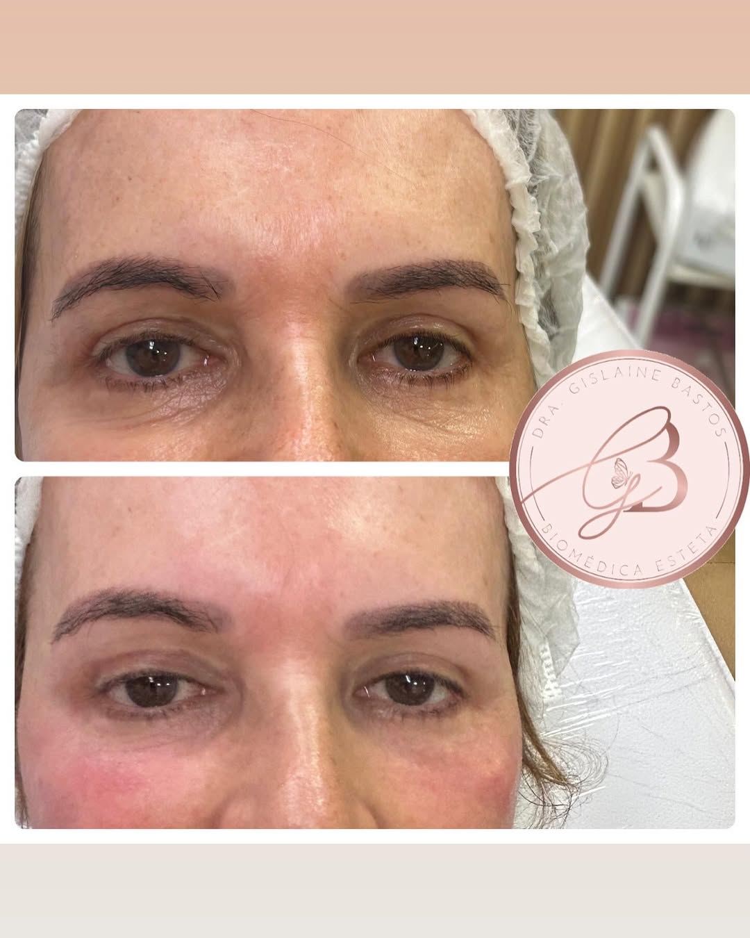 Tratamento de Olheiras