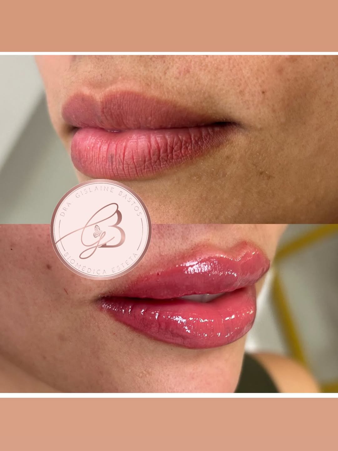 Harmonização Labial