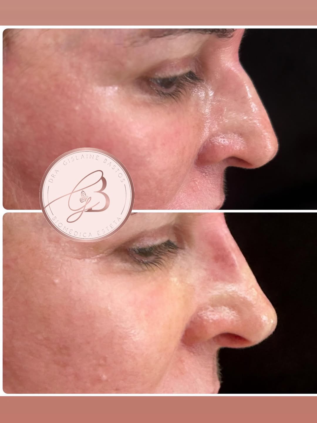 Harmonização Nasal